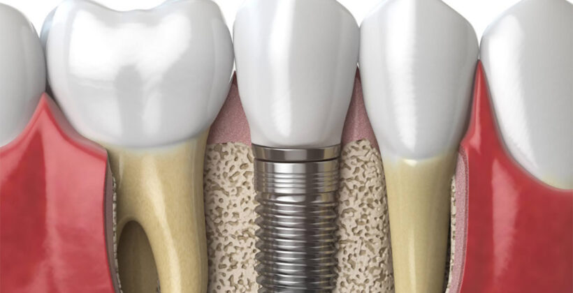 Zapreke za ugradnju zubnog implantata