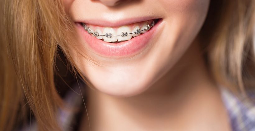 Sve što trebate znati o fiksnom aparatiću!