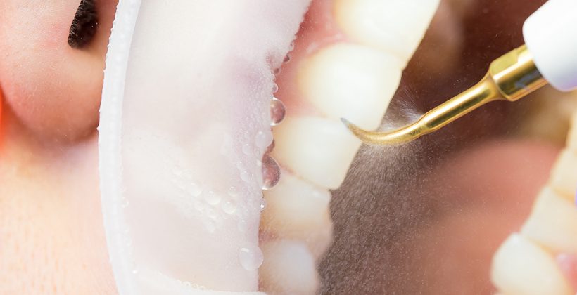 Dubinsko čišćenje zubi