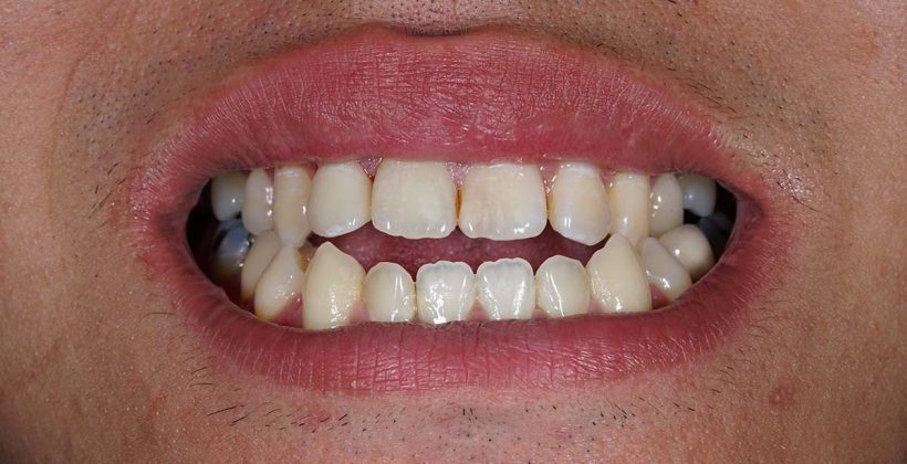 Nepravilan zagriz ili malokluzija