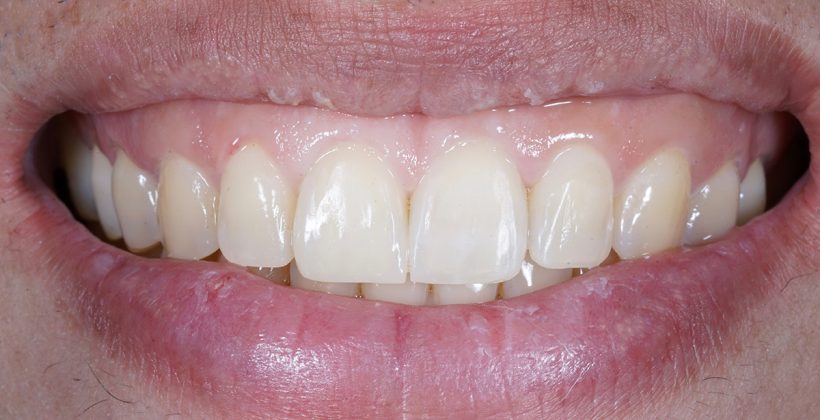 Što je “Gummy smile” i kako ga riješiti