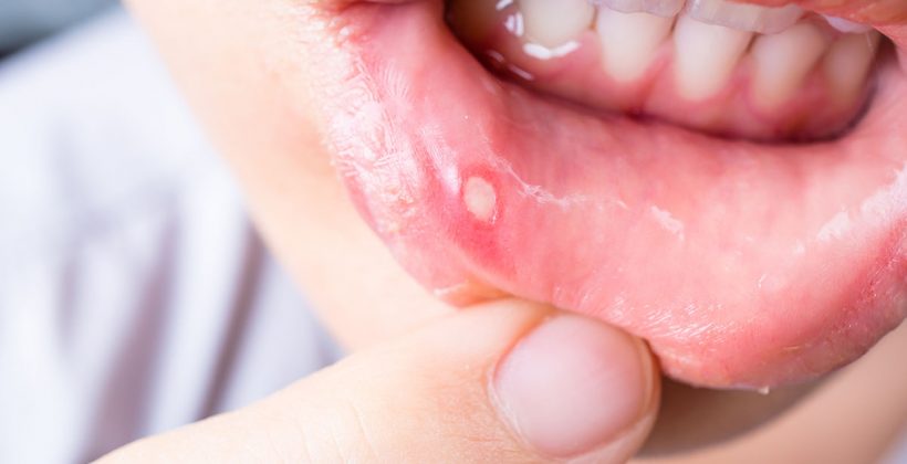 Afte – simptomi, uzroci i prevencija