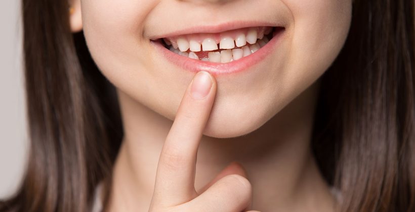 Karijes u ranom djetinjstvu