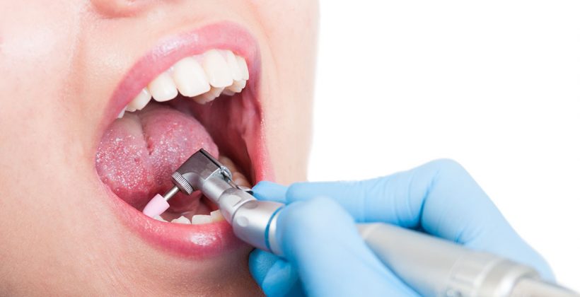 Profesionalno čišćenje zubi