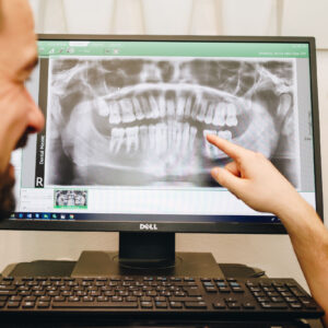 Povlačenje kosti nakon vađenja zuba