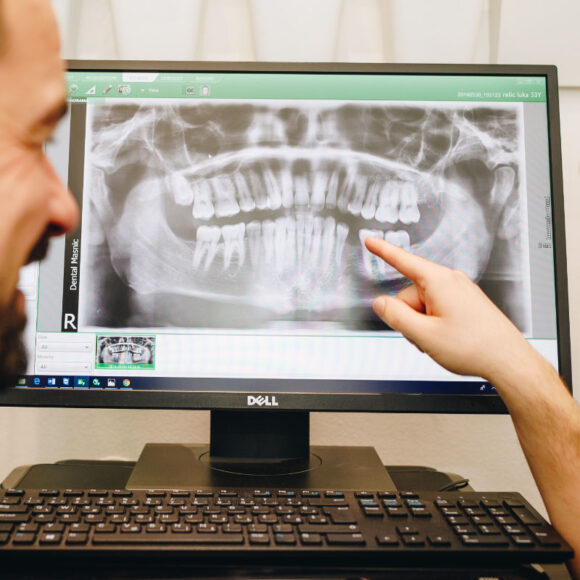 Povlačenje kosti nakon vađenja zuba